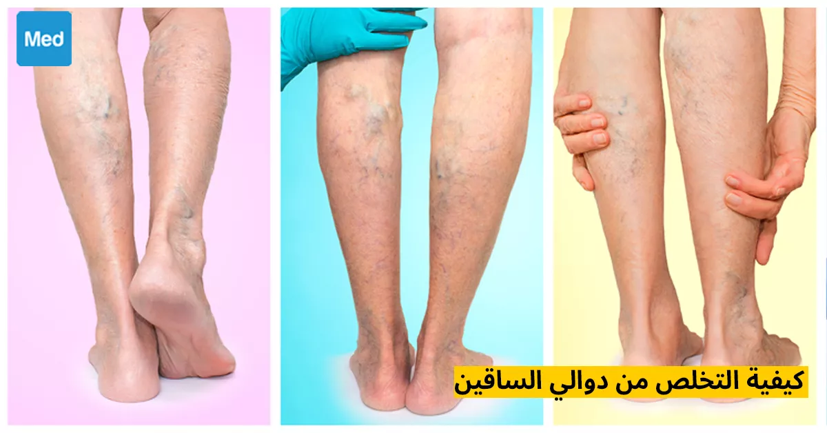 كيفية التخلص من دوالي الساقين